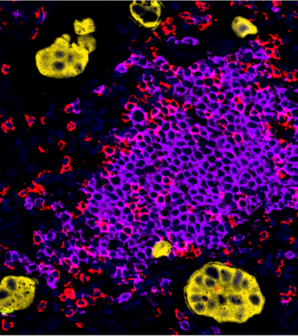 肿瘤组织三级淋巴结构 (TLS) 检测 (多重免疫荧光)
