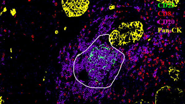 人肺癌组织 成熟三级淋巴结构