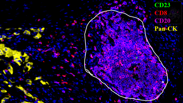 人肺癌组织 未成熟三级淋巴结构