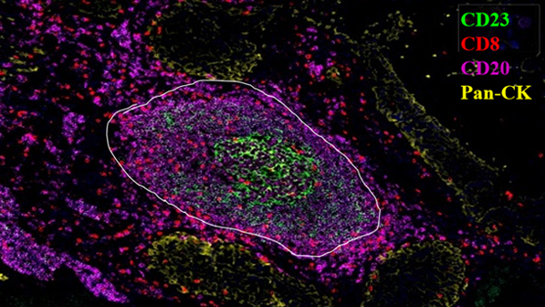 人胃癌组织 成熟三级淋巴结构