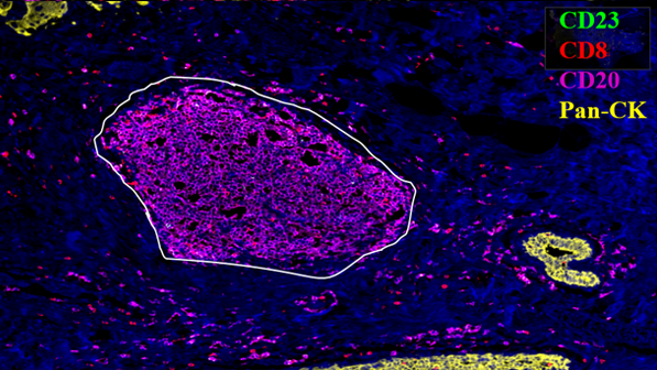 人胃癌组织 未成熟三级淋巴结构