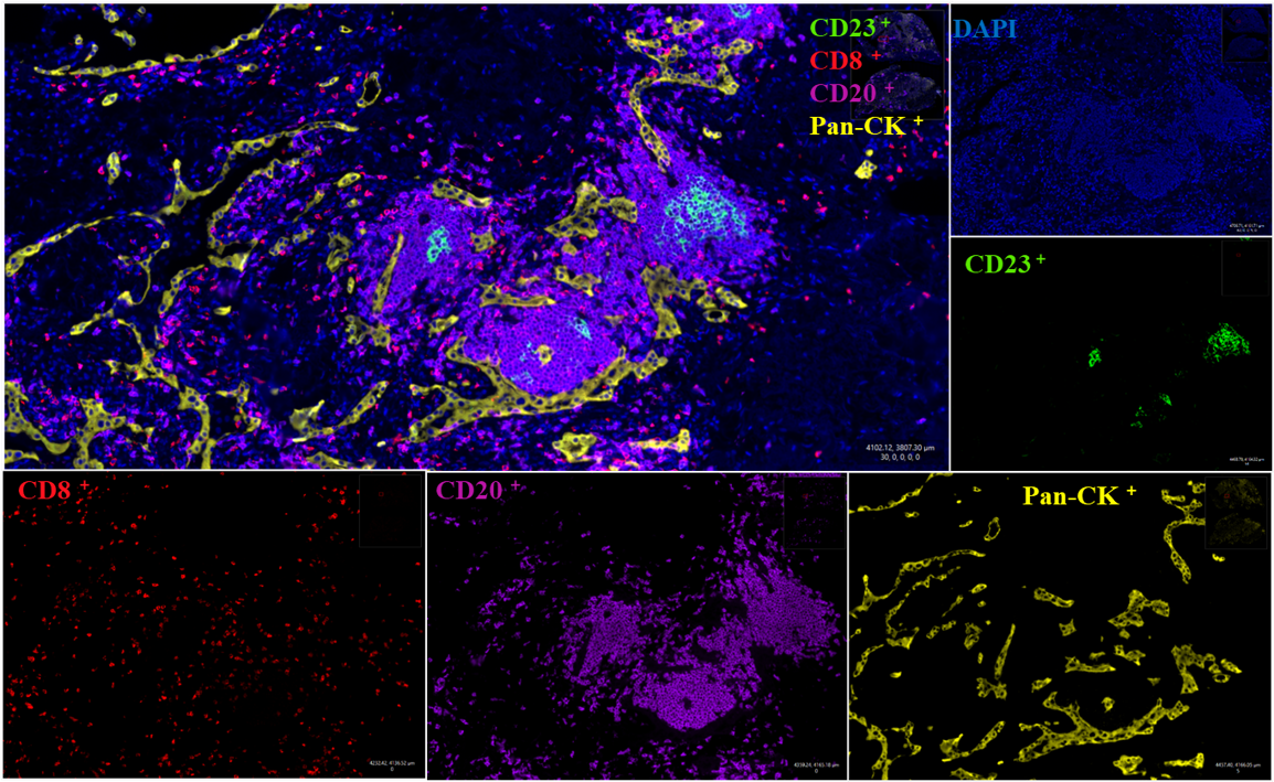 人肺癌组织三级淋巴结构
使用20× 0.8物镜成像
蓝色：细胞核；绿色：CD23；红色：CD8；紫色：CD20；黄色：Pan-CK；