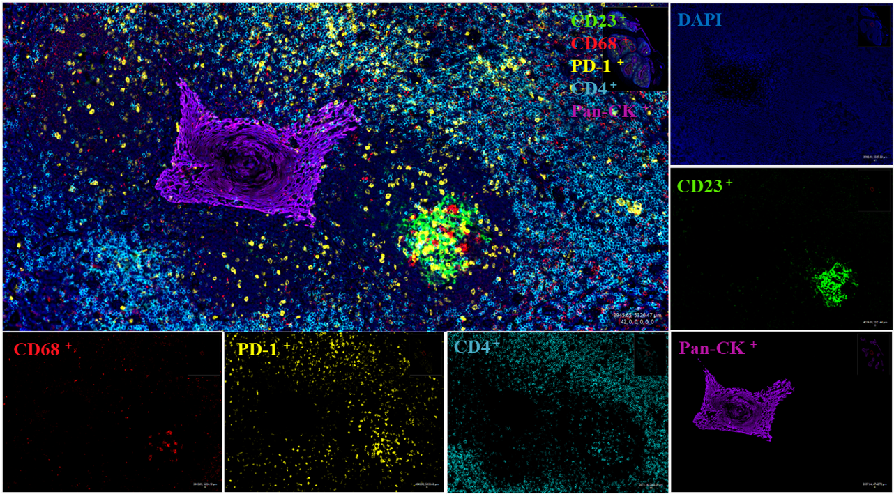 人扁桃体组织
使用20× 0.8物镜成像
蓝色：细胞核；绿色：CD23；红色：CD8；黄色：PD-1；紫色：Pan-CK；