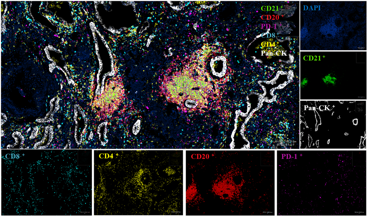 人肺癌组织
使用20× 0.8物镜成像
蓝色：细胞核；绿色：CD21；白色：Pan-CK；青色：CD8 ；黄色：CD4；红色：CD20；紫色：PD-1；